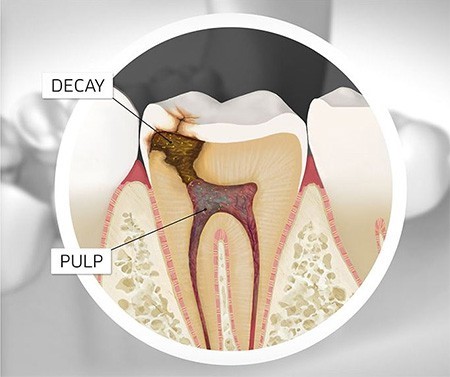 Root Canal Treatment