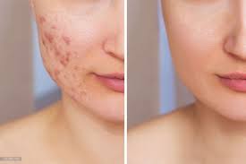 Scar Treatment in Noida